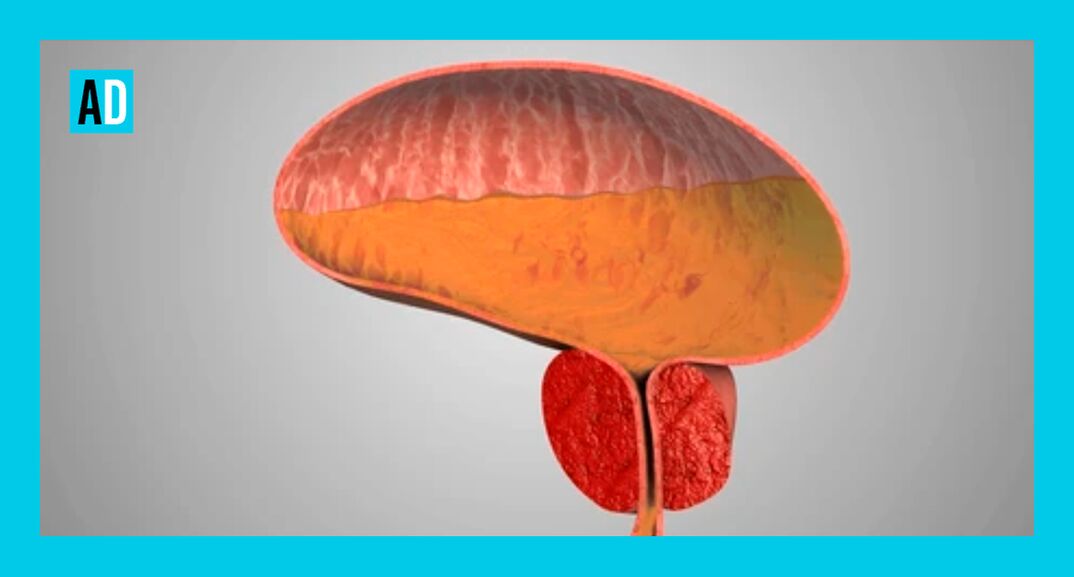 Ontstoken prostaatklier